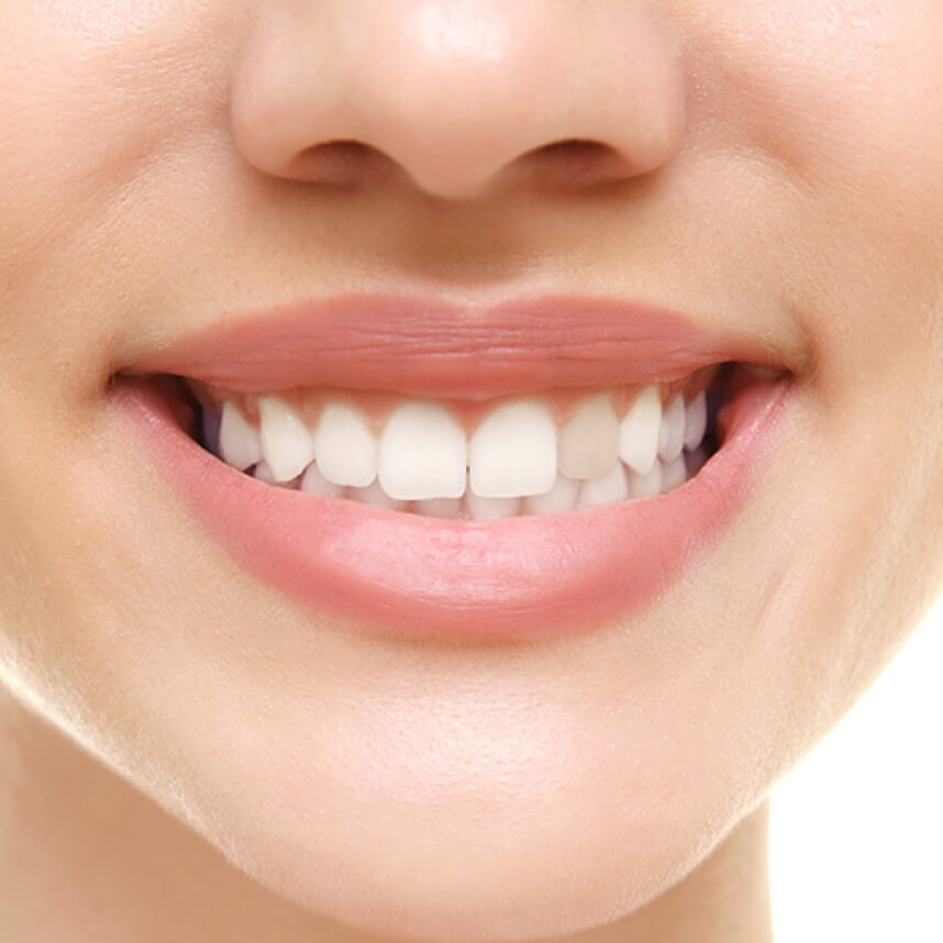 Internes Bleaching Vorher