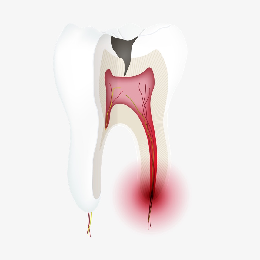 Endodontie zahnaufbau