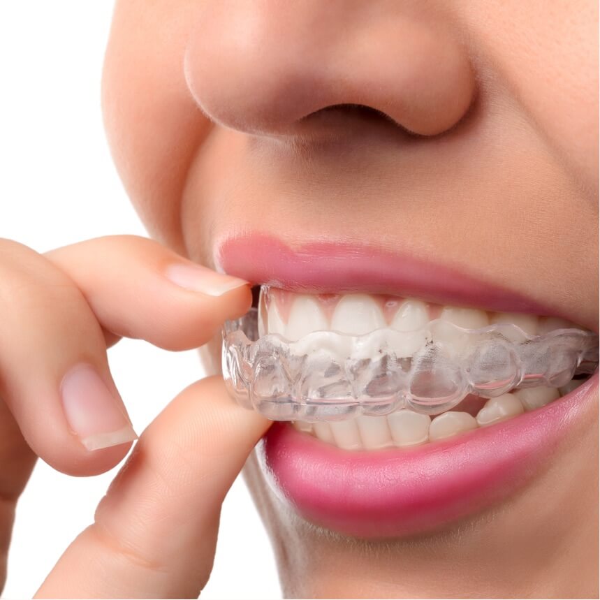 invisalign go schiene