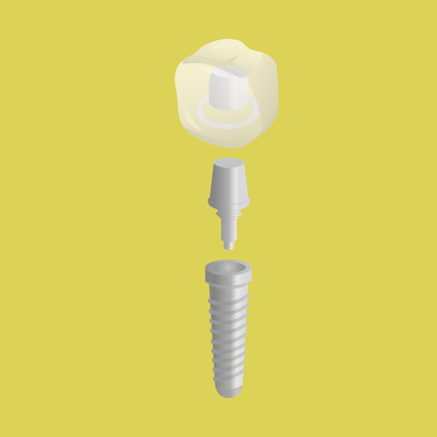 Implantatgetragener Zahnersatz