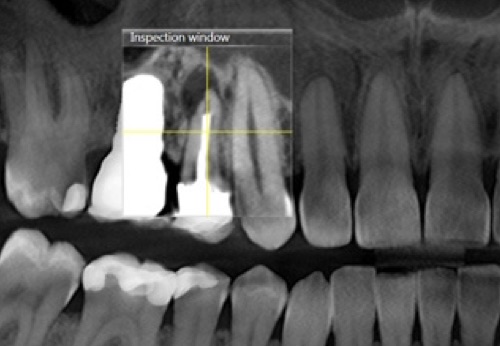 teaser endo dvt