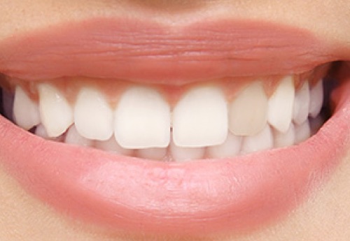 teaser internes bleaching